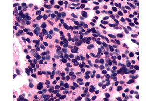 Anti-Encephalopsin / OPN3 antibody IHC of human Lung, Small Cell Carcinoma. (OPN3 antibody  (C-Term))