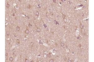 Paraformaldehyde-fixed, paraffin embedded human glioma, Antigen retrieval by boiling in sodium citrate buffer (pH6) for 15min, Block endogenous peroxidase by 3% hydrogen peroxide for 30 minutes,  Blocking buffer (normal goat serum) at 37°C for 20min, Antibody incubation with PTPN6(Tyr536) Polyclonal Antibody (bs-5577R) at 1:400 overnight at 4°C, followed by a conjugated secondary and DAB staining. (SHP1 antibody  (pTyr536))