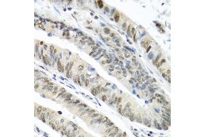 Immunohistochemistry of paraffin-embedded human colon carcinoma using TIA1 antibody (ABIN6293426) at dilution of 1:100 (40x lens). (TIA1 antibody)