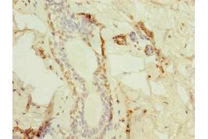 Immunohistochemistry of paraffin-embedded human breast cancer using ABIN7172975 at dilution of 1:100 (TMED2 antibody  (AA 26-111))
