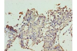 Immunohistochemistry of paraffin-embedded human breast cancer using ABIN7171951 at dilution of 1:100 (TTC9C antibody  (AA 1-171))
