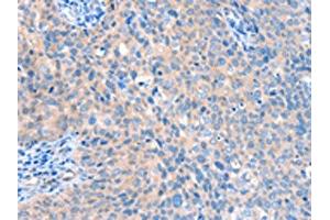 The image on the left is immunohistochemistry of paraffin-embedded Human cervical cancer tissue using ABIN7128170(ACOX1 Antibody) at dilution 1/20, on the right is treated with fusion protein. (ACOX1 antibody)