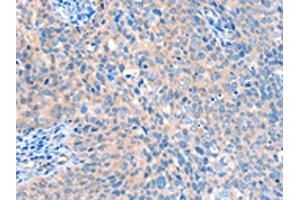 The image on the left is immunohistochemistry of paraffin-embedded Human cervical cancer tissue using ABIN7128170(ACOX1 Antibody) at dilution 1/20, on the right is treated with fusion protein. (ACOX1 antibody)