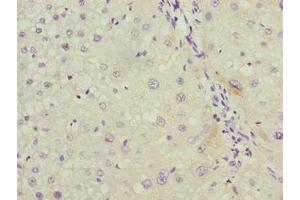Immunohistochemistry of paraffin-embedded human liver cancer using ABIN7158038 at dilution of 1:100 (LRG1 antibody  (AA 36-346))