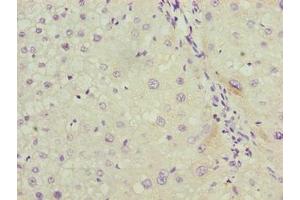 Immunohistochemistry of paraffin-embedded human liver cancer using ABIN7158038 at dilution of 1:100 (LRG1 antibody  (AA 36-346))