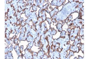 Formalin-fixed, paraffin-embedded human Angiosarcoma stained with CD31 Rabbit Recombinant Monoclonal Antibody (C31/2876R).