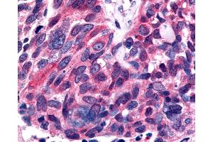 Anti-ESRRB / ERR Beta antibody IHC of human Lung, Small Cell Carcinoma. (ESRRB antibody  (Ligand Binding Domain))