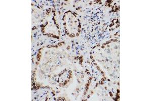 Anti-Lamin A+C antibody, IHC(P) IHC(P): Human Lung Cancer Tissue