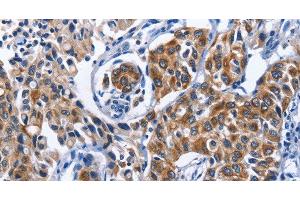 Immunohistochemistry of paraffin-embedded Human lung cancer tissue using MYH1 Polyclonal Antibody at dilution 1:40 (MYH1 antibody)