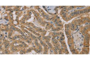 Immunohistochemistry of paraffin-embedded Human thyroid cancer using MVK Polyclonal Antibody at dilution of 1:40 (MVK antibody)