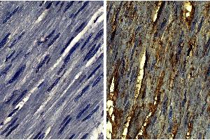 Paraffin embedded human gastric cancer tissue was stained with Goat IgG-UNLB isotype control, DAB, and hematoxylin. (COL6 antibody  (Biotin))