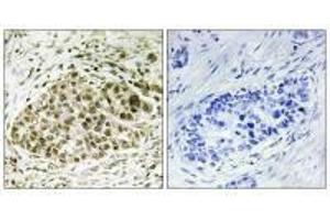 Immunohistochemistry analysis of paraffin-embedded human lung carcinoma tissue, using Lyl-1 antibody.