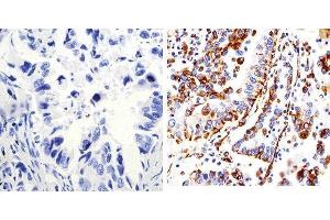 Immunohistochemistry analysis of Connexin 43 showing staining in the membrane of paraffin-embedded human lung adenocarcinoma (right) compared to a negative control without primary antibody (left). (Connexin 43/GJA1 antibody  (C-Term))