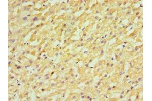 Immunohistochemistry of paraffin-embedded human liver cancer using ABIN7170658 at dilution of 1:100 (FDFT1 antibody  (AA 1-260))
