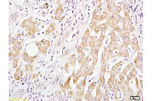 Formalin-fixed and paraffin embedded human liver carcinoma labeled with Anti-BAAT Polyclonal Antibody, Unconjugated (ABIN708776) at 1:200 followed by conjugation to the secondary antibody and DAB staining.
