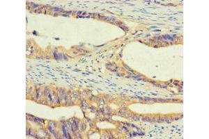 Immunohistochemistry of paraffin-embedded human colon cancer using ABIN7174635 at dilution of 1:100 (UGT2A3 antibody  (AA 201-491))