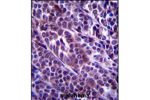 ARMC9 Antibody (N-term) (ABIN657366 and ABIN2846413) immunohistochemistry analysis in formalin fixed and paraffin embedded human melanoma followed by peroxidase conjugation of the secondary antibody and DAB staining. (ARMC9 antibody  (N-Term))