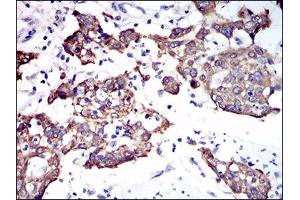 Immunohistochemical analysis of paraffin-embedded esophagus cancer tissues using CK5 mouse mAb with DAB staining. (Cytokeratin 5 antibody  (AA 316-590))