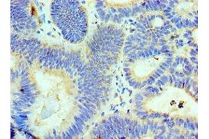 Immunohistochemistry of paraffin-embedded human colon cancer using ABIN7143718 at dilution of 1:100 (ALKBH8 antibody  (AA 1-230))