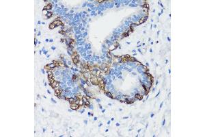 Immunohistochemistry of paraffin-embedded human breast cancer using Filamin A antibody (ABIN7267206) at dilution of 1:100 (40x lens). (Filamin A antibody  (C-Term))