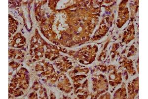 IHC image of ABIN7144072 diluted at 1:348 and staining in paraffin-embedded human pancreatic cancer performed on a Leica BondTM system. (ANAPC2 antibody  (AA 1-230))