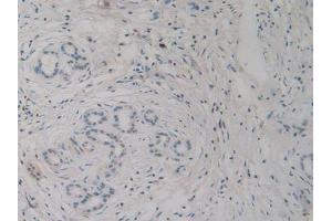 IHC-P analysis of Human Pancreas Cancer Tissue, with DAB staining. (H2AFY antibody  (AA 109-369))