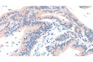 Immunohistochemistry of paraffin-embedded Human colon cancer tissue using ITGA6 Polyclonal Antibody at dilution 1:50 (ITGA6 antibody)