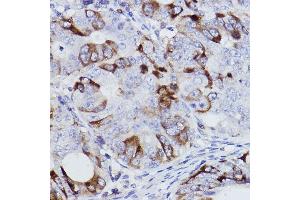 Immunohistochemistry of paraffin-embedded human colon carcinoma using [KO Validated] Cyclin B1 Rabbit mAb (ABIN7266553) at dilution of 1:100 (40x lens). (Cyclin B1 antibody)