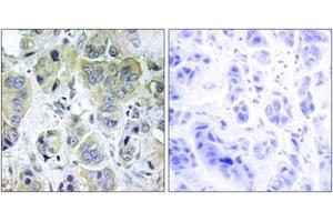 Immunohistochemistry analysis of paraffin-embedded human breast carcinoma tissue, using p70 S6 Kinase (Ab-411) Antibody. (RPS6KB1 antibody  (AA 401-450))