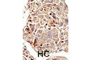 Formalin-fixed and paraffin-embedded human hepatocellular carcinoma tissue reacted with ACVR1 polyclonal antibody  , which was peroxidase-conjugated to the secondary antibody, followed by DAB staining. (ACVR1 antibody  (Internal Region))