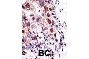 Formalin-fixed and paraffin-embedded human cancer tissue reacted with UBE2S polyclonal antibody  , which was peroxidase-conjugated to the secondary antibody, followed by AEC staining. (UBE2S antibody  (N-Term))