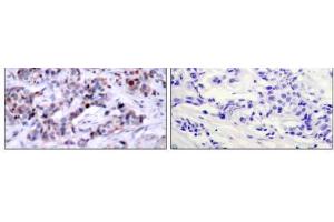 Immunohistochemical analysis of paraffin-embedded human breast carcinoma tissue using NF-κB p65 (phospho-Thr435) antibody (E011012). (NF-kB p65 antibody  (pThr435))