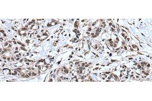 Immunohistochemistry of paraffin-embedded Human gastric cancer tissue using TIA1 Polyclonal Antibody at dilution of 1:30(x200) (TIA1 antibody)