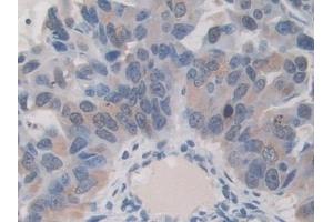 Detection of ITIH1 in Human Breast cancer Tissue using Polyclonal Antibody to Inter Alpha-Globulin Inhibitor H1 (ITIH1) (ITIH1 antibody  (AA 507-819))