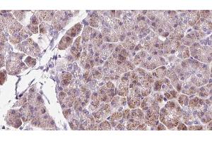 ABIN6273232 at 1/100 staining Human pancreas cancer tissue by IHC-P. (DBN1 antibody  (Internal Region))