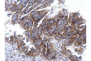 IHC-P Image CCR3 antibody [C2C3], C-term detects CCR3 protein at cytosol on human ovarian carcinoma by immunohistochemical analysis. (CCR3 antibody  (C-Term))