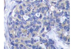 Immunohistochemistry analyzes of ZAP-70 antibody in paraffin-embedded human breast carcinoma tissue. (ZAP70 antibody)