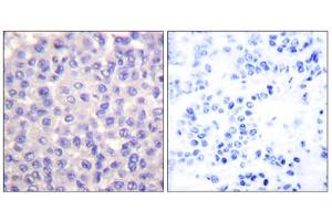 Immunohistochemical analysis of paraffin-embedded human breast carcinoma tissue using TGF beta 3 antibody (ABIN5976517). (TGFB3 antibody  (Internal Region))