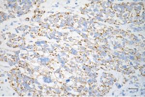 Immunohistochemistry was performed on paraffin-embedded human breast carcinoma using fumarate hydratase antibody (ABIN7798665), 1:200). (FH antibody)