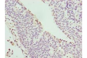 Immunohistochemistry of paraffin-embedded human bladder cancer using ABIN7149090 at dilution of 1:100 (CYBC1 (AA 43-187) antibody)