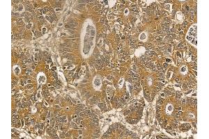 MOGAT2 Mouse Monoclonal Antibody at 1/100 staining human colorectal cancer by IHC-P.