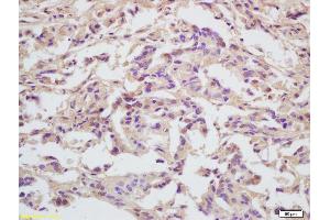 Formalin-fixed and paraffin embedded human gastric carcinoma labeled with Anti-MCM5 Polyclonal Antibody, Unconjugated (ABIN749648) at 1:200 followed by conjugation to the secondary antibody and DAB staining