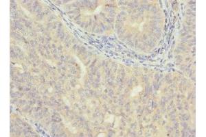 Immunohistochemistry of paraffin-embedded human endometrial cancer using ABIN7175638 at dilution of 1:100 (VHLL antibody  (AA 1-139))
