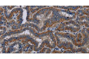 Immunohistochemistry of paraffin-embedded Human thyroid cancer tissue using KLK11 Polyclonal Antibody at dilution 1:40