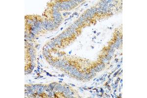 Immunohistochemistry of paraffin-embedded human colon carcinoma using COPA Rabbit mAb (ABIN7266423) at dilution of 1:100 (40x lens). (COPA antibody)
