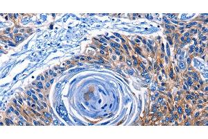 Immunohistochemistry of paraffin-embedded Human esophagus cancer tissue using CLEC2B Polyclonal Antibody at dilution 1:50 (CLEC2B antibody)