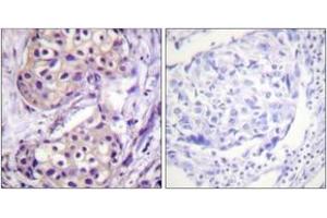 Immunohistochemistry analysis of paraffin-embedded human breast carcinoma tissue, using IKK-beta (Ab-199) Antibody.