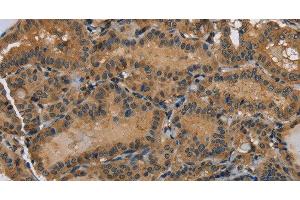 Immunohistochemistry of paraffin-embedded Human thyroid cancer using HSP40-4 Polyclonal Antibody at dilution of 1:60 (HSP40-4 antibody)