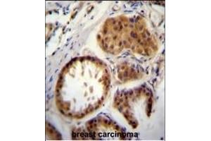 E2EPF Antibody (C-term) (ABIN388858 and ABIN2839160) immunohistochemistry analysis in formalin fixed and paraffin embedded human breast carcinoma followed by peroxidase conjugation of the secondary antibody and DAB staining. (UBE2S antibody  (C-Term))