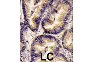 Formalin-fixed and paraffin-embedded human lung carcinoma tissue reacted with VEGF2 antibody , which was peroxidase-conjugated to the secondary antibody, followed by DAB staining. (VEGFB antibody  (AA 110-139))